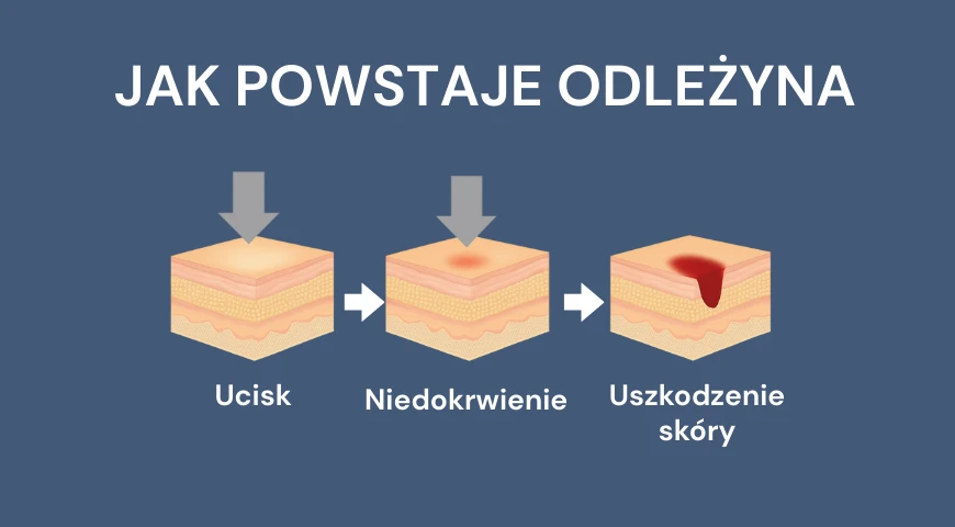 Odleżyny potrafią rozwijać się bardzo szybko